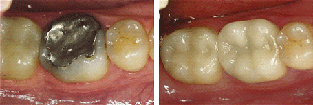 Before Crowns and After Crowns