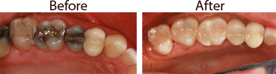 Before and After Dental Fillings