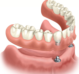 Implant Supported Denture