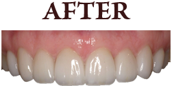 After Veneers